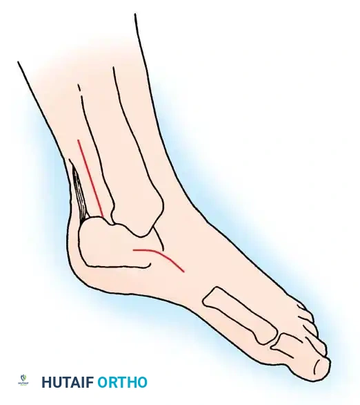 MUSCULAR DYSTROPHY Surgical Diagram