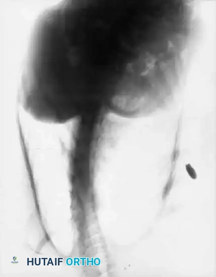 MUSCULAR DYSTROPHY Surgical Diagram