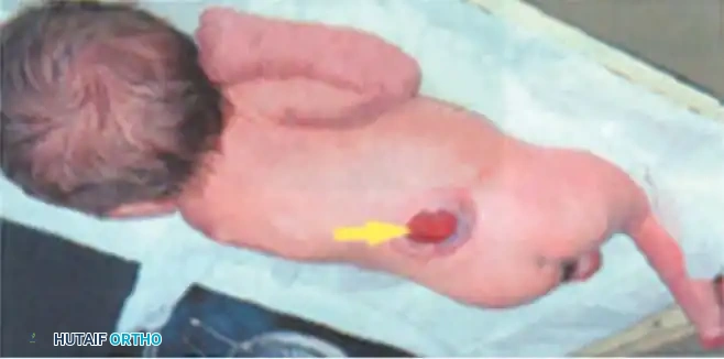 Myelomeningocele: Comprehensive Orthopaedic Management and Surgical Principles