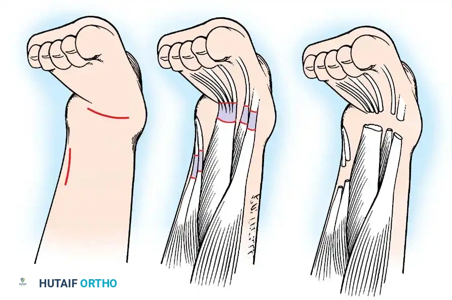 Hip Subluxation AP Pelvis