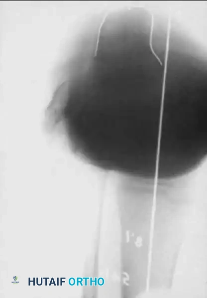 Knee Flexion Contracture Release