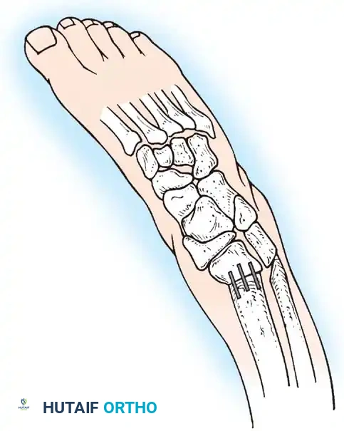 VDRO Preoperative Planning