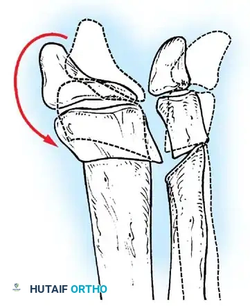 Ponseti Casting Technique