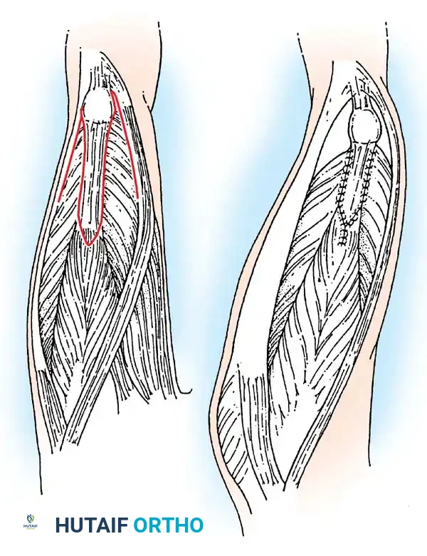 Arnold-Chiari Malformation