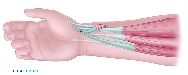 MYOTOMY Surgical Diagram