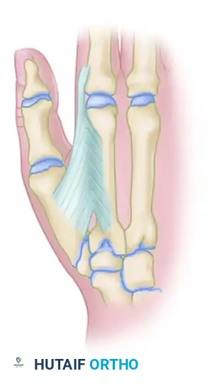 MYOTOMY Surgical Diagram