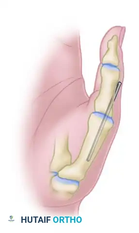 MYOTOMY Surgical Diagram