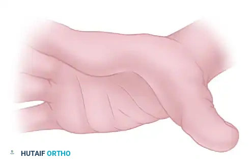 MYOTOMY Surgical Diagram