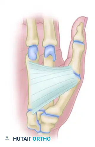 MYOTOMY Surgical Diagram