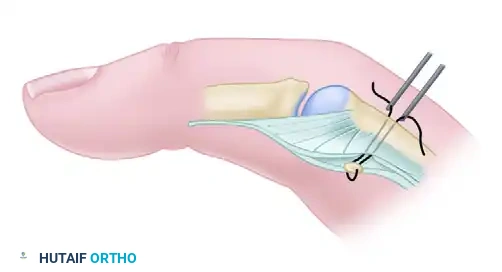 MYOTOMY Surgical Diagram