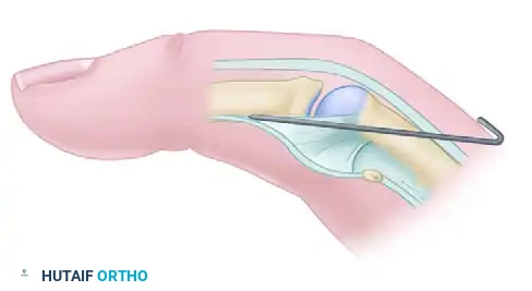 MYOTOMY Surgical Diagram