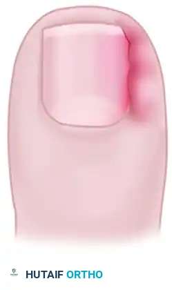 FIGURE 87-16 Recurrence of nail spicules after wedge resection.