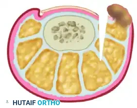 FIGURE 87-18 Soft tissue wedge resection for ingrown toenail...