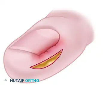 NAIL FOLD REMOVAL OR REDUCTION Surgical Diagram