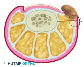 NAIL FOLD REMOVAL OR REDUCTION Surgical Diagram