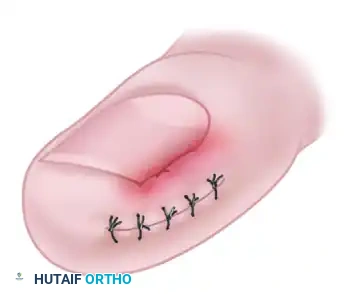 NAIL FOLD REMOVAL OR REDUCTION Surgical Diagram