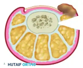 NAIL FOLD REMOVAL OR REDUCTION Surgical Diagram