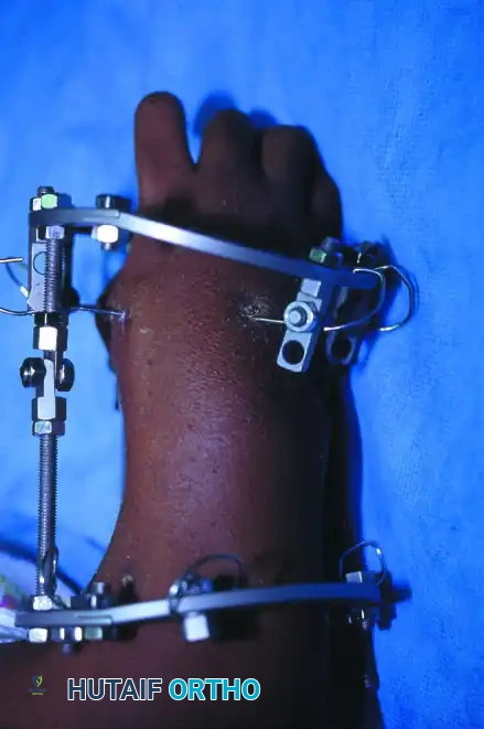 Mastering Longitudinal Deficiencies and the Krukenberg Reconstruction