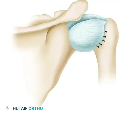 NEER INFERIOR CAPSULAR SHIFT PROCEDURE THROUGH A POSTERIOR APPROACH Surgical Diagram