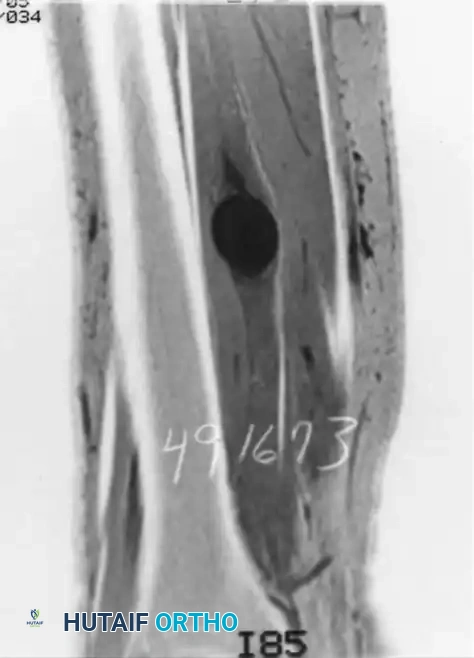 Gross Specimen Neurilemoma