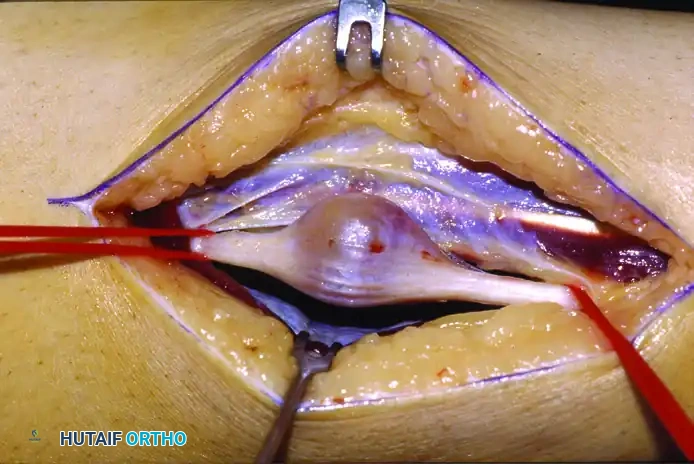 Intraoperative Neurilemoma