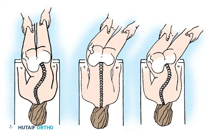NEUROMUSCULAR SCOLIOSIS Surgical Diagram
