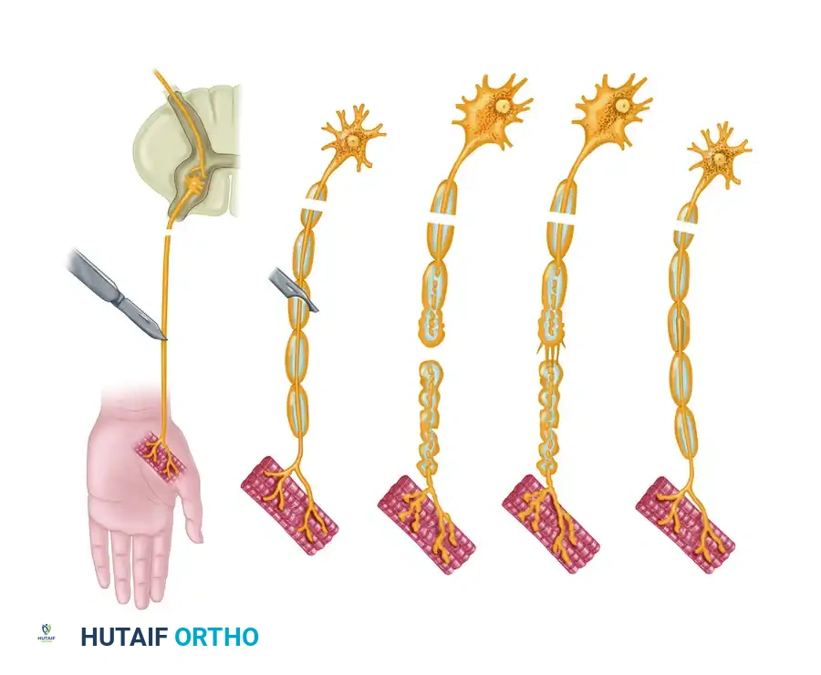 Peripheral Nerve Injury: Pathophysiology, Degeneration, and Microsurgical Repair
