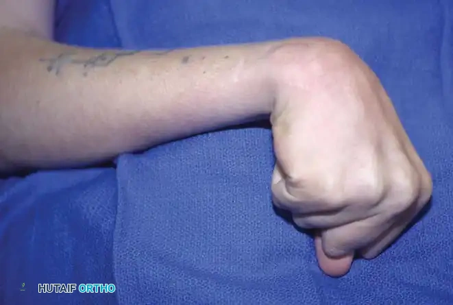 Fig. 69-1 Typical upper extremity deformities in cerebral palsy. Elbow ﬂ exion, forearm pronation, and wrist and ﬁ nger ﬂ exion.