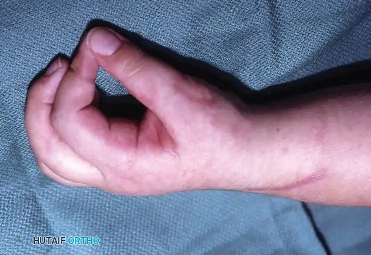 NONOPERATIVE MANAGEMENT Surgical Diagram