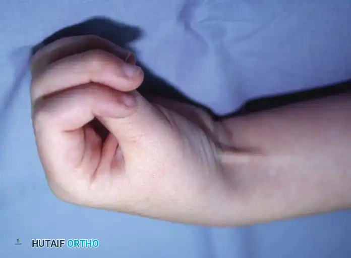 NONOPERATIVE MANAGEMENT Surgical Diagram