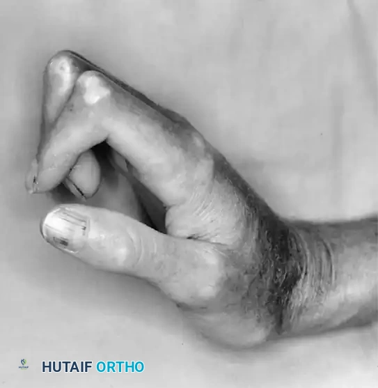 Management of Inflammatory Hand Pathologies: Synovitis, Nodules, and Surgical Staging