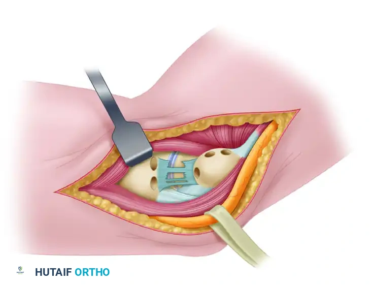 NONOPERATIVE TREATMENT Surgical Diagram