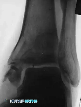 Management of Tibial, Malleolar, and Metatarsal Nonunions