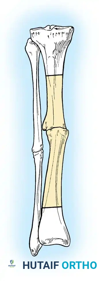Mastering the Surgical Management of Lower Extremity Nonunions: Tibia and Foot