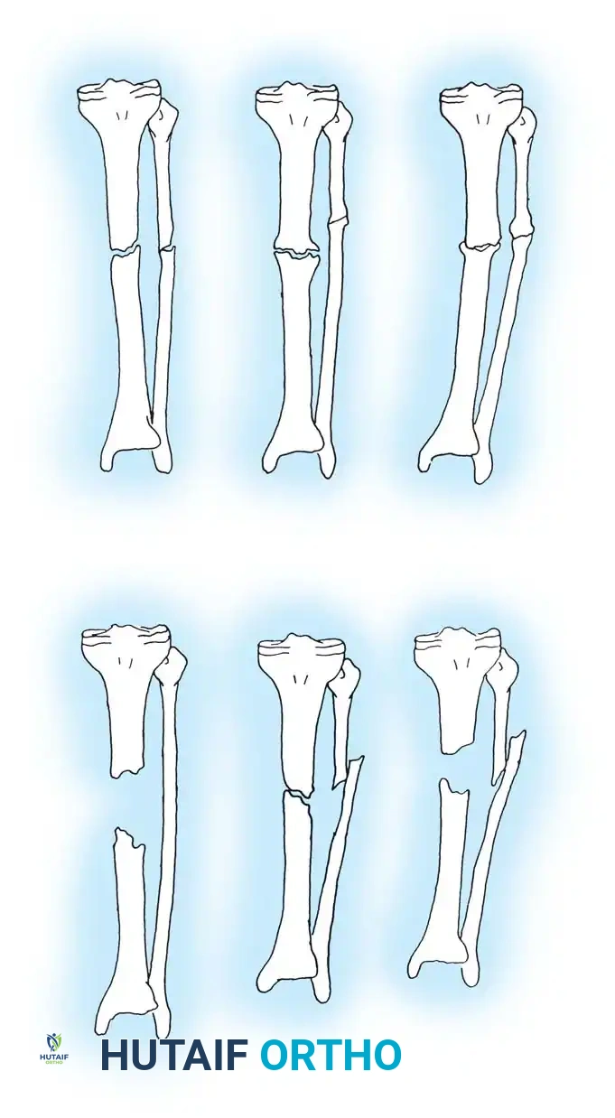 NONUNION Surgical Diagram