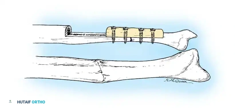 NONUNION Surgical Diagram