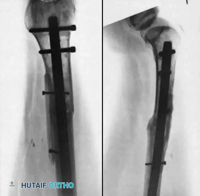 NONUNION Surgical Diagram