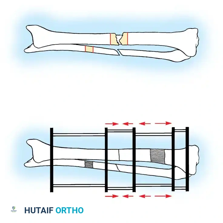 NONUNION Surgical Diagram