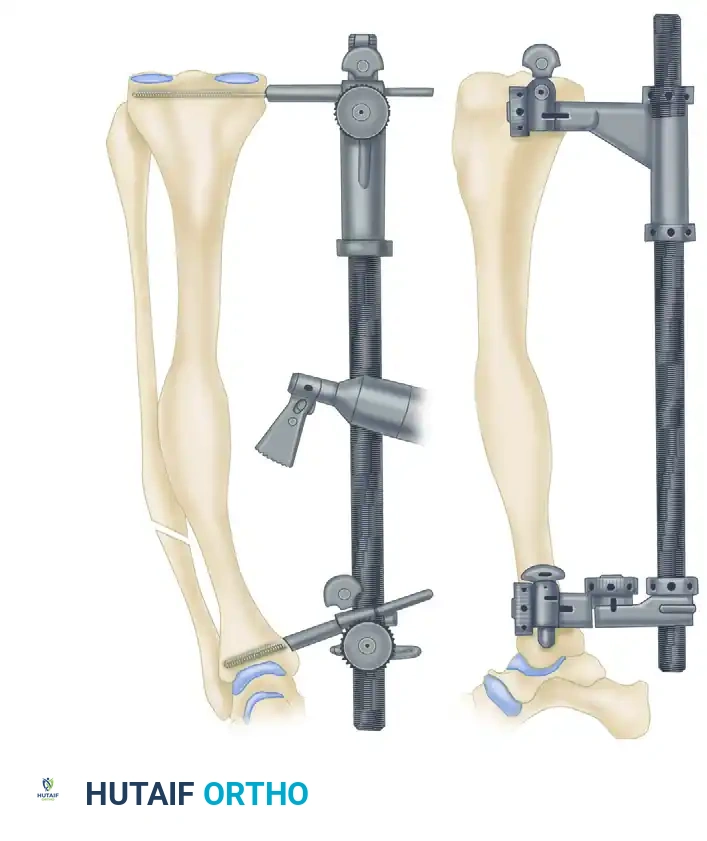 Oblique Tibial Osteotomy: Surgical Technique & Protocol