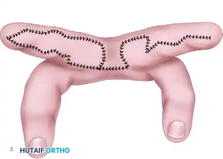 Open Finger Syndactyly Release and Dorsal Flap Reconstruction