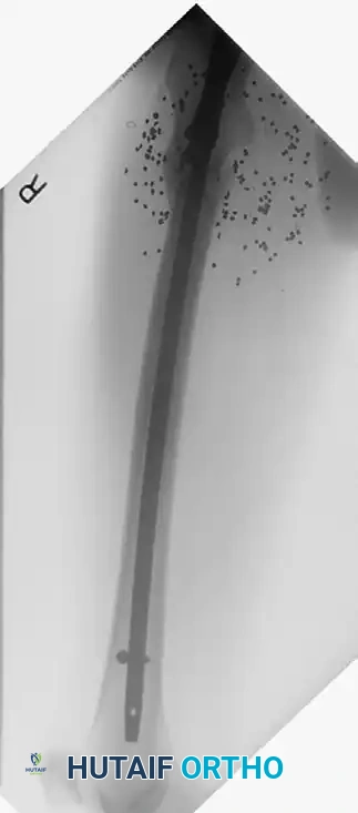 الدمار العظمي الناتج عن الأسلحة النارية عالية السرعة