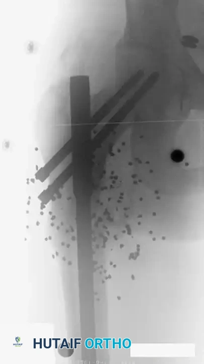 إصابات الطلق الناري عالي السرعة والضرر النسيجي الواسع