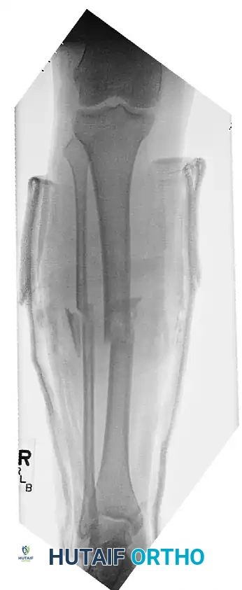 إصلاح الأوعية الدموية وتثبيت الكسر