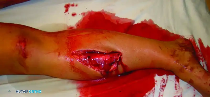 الكسور المفتوحة الشديدة في عظمة الساق