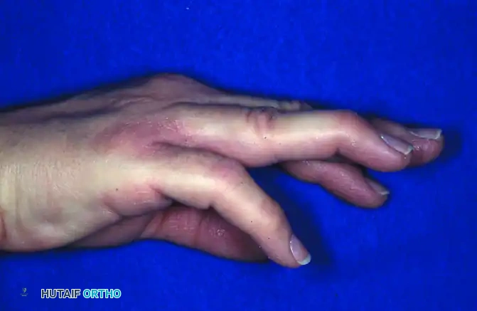 OPEN REDUCTION AND FIXATION WITH A KIRSCHNER WIRE Surgical Diagram