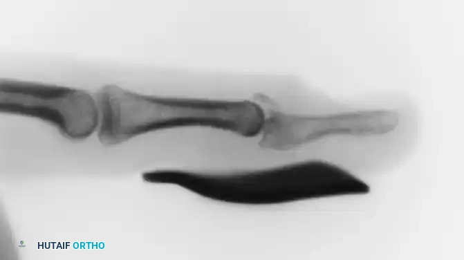 Open Reduction and K-Wire Fixation of Phalangeal Fractures