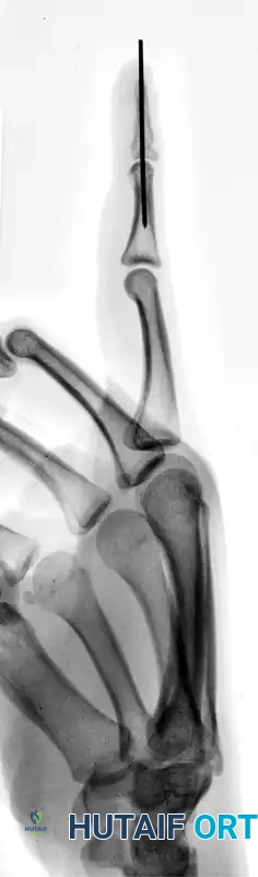 OPEN REDUCTION AND FIXATION WITH A KIRSCHNER WIRE Surgical Diagram
