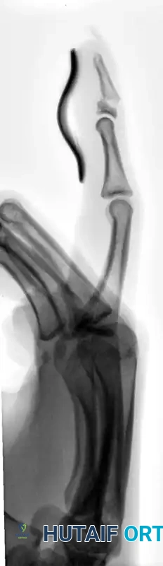OPEN REDUCTION AND FIXATION WITH A KIRSCHNER WIRE Surgical Diagram