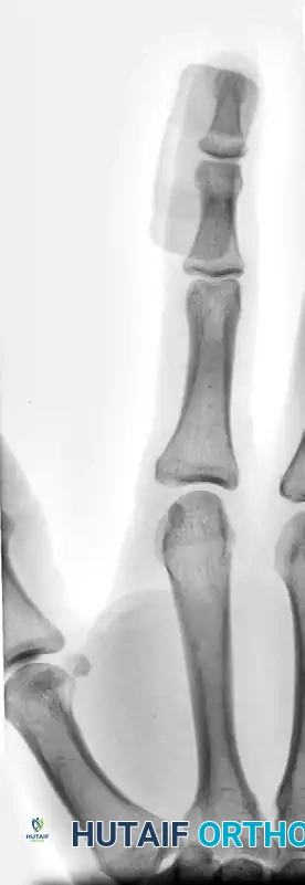 OPEN REDUCTION AND FIXATION WITH A KIRSCHNER WIRE Surgical Diagram