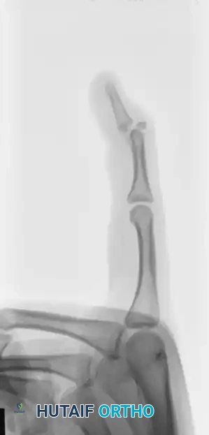 OPEN REDUCTION AND FIXATION WITH A KIRSCHNER WIRE Surgical Diagram